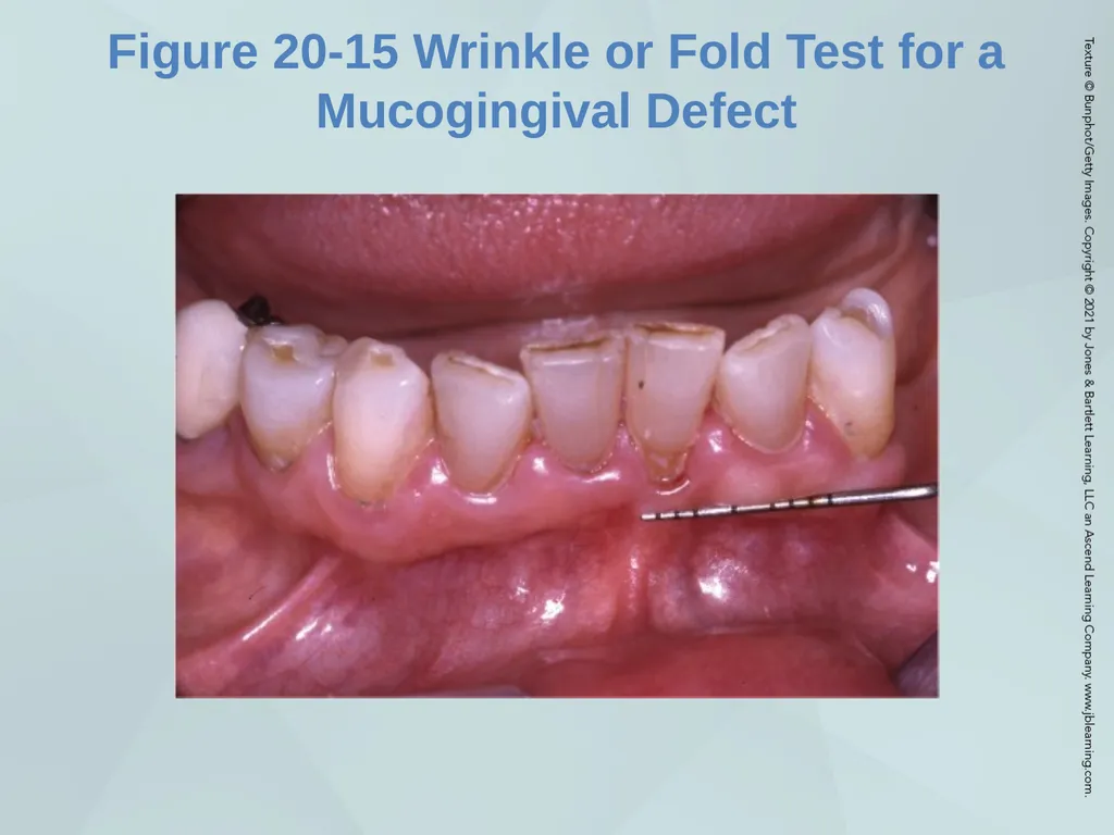 Chapter 20 Periodontal Examination Learning - slide 35 of 49