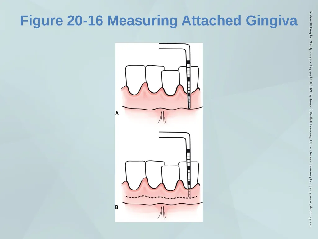 Chapter 20 Periodontal Examination Learning - slide 36 of 49