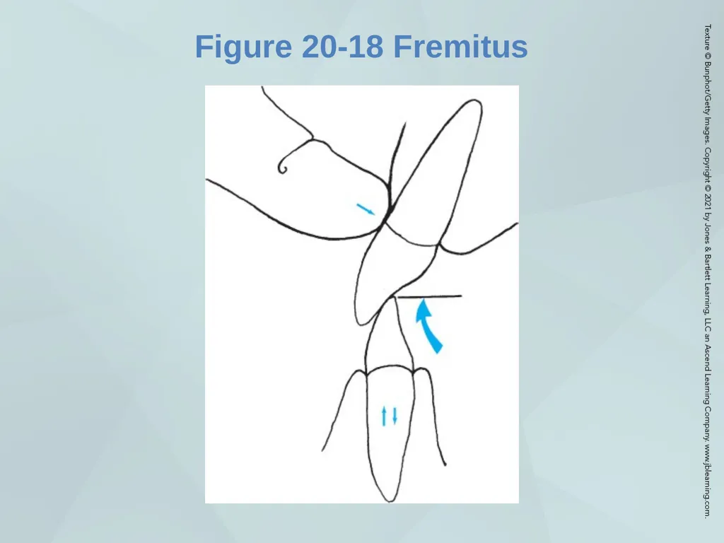 Chapter 20 Periodontal Examination Learning - slide 39 of 49