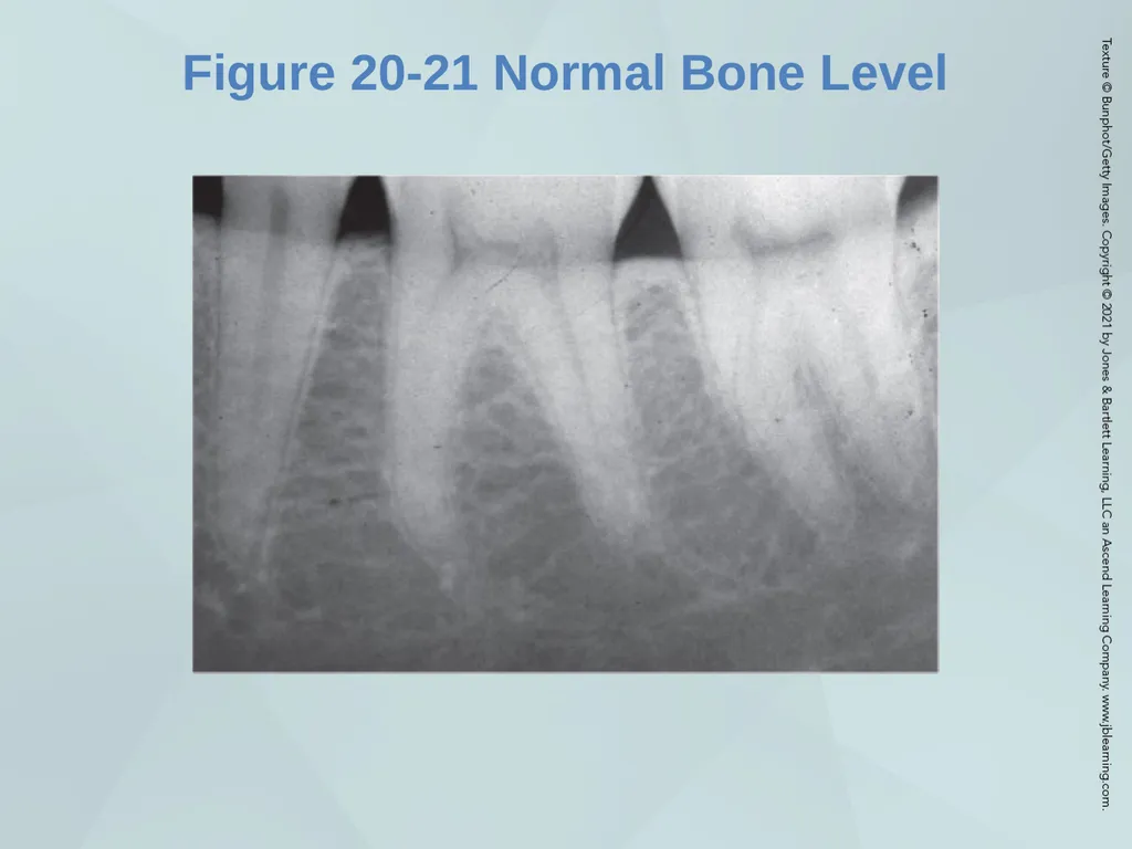 Chapter 20 Periodontal Examination Learning - slide 42 of 49