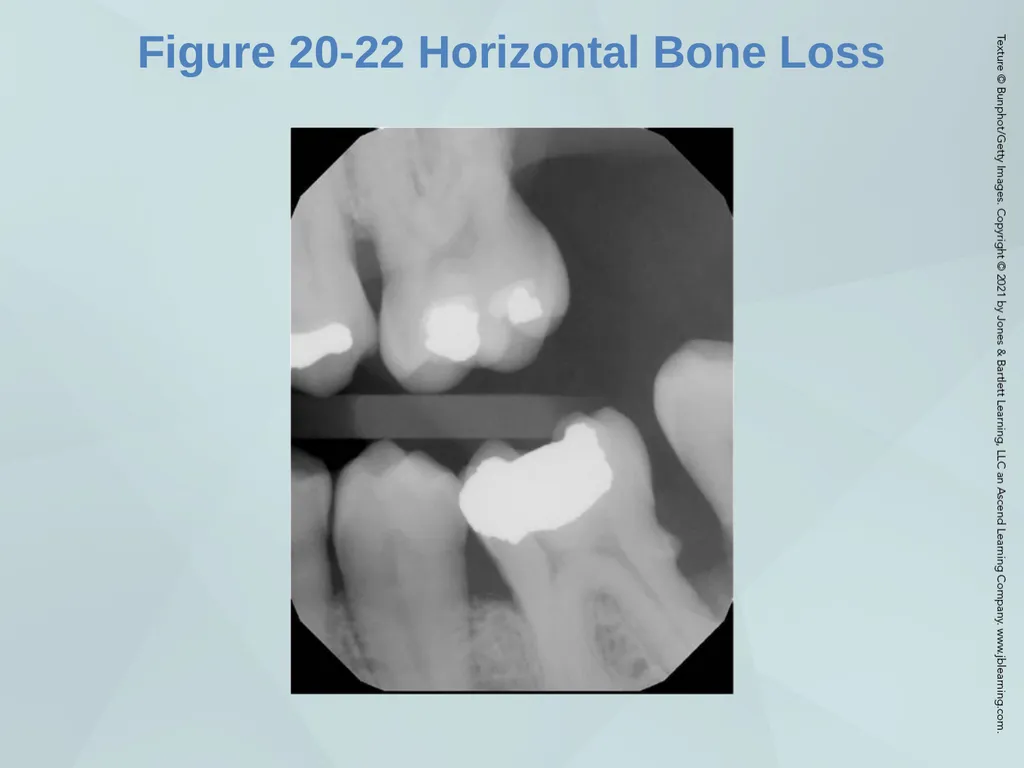Chapter 20 Periodontal Examination Learning - slide 43 of 49