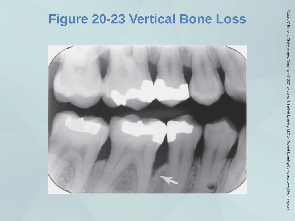 Chapter 20 Periodontal Examination Learning - slide 44 of 49
