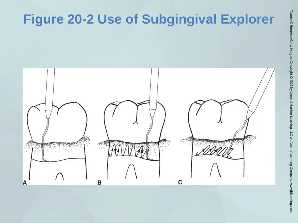 Chapter 20 Periodontal Examination Learning - slide 14 of 49