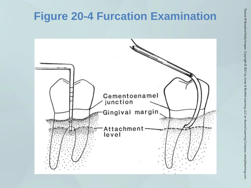 Chapter 20 Periodontal Examination Learning - slide 17 of 49