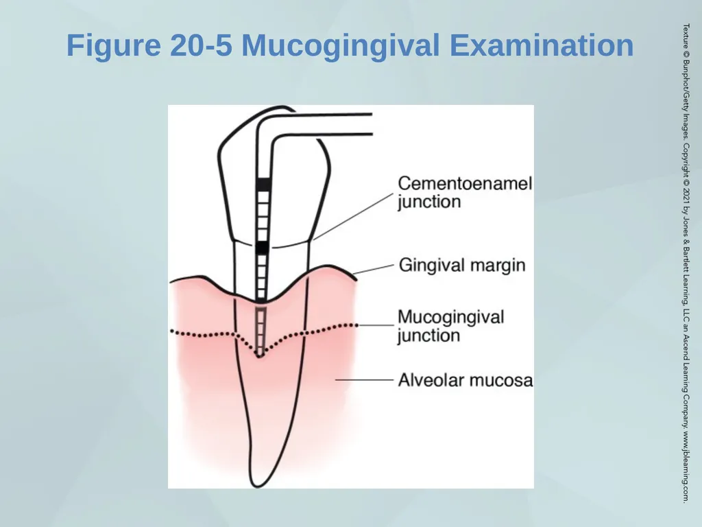 Chapter 20 Periodontal Examination Learning - slide 19 of 49