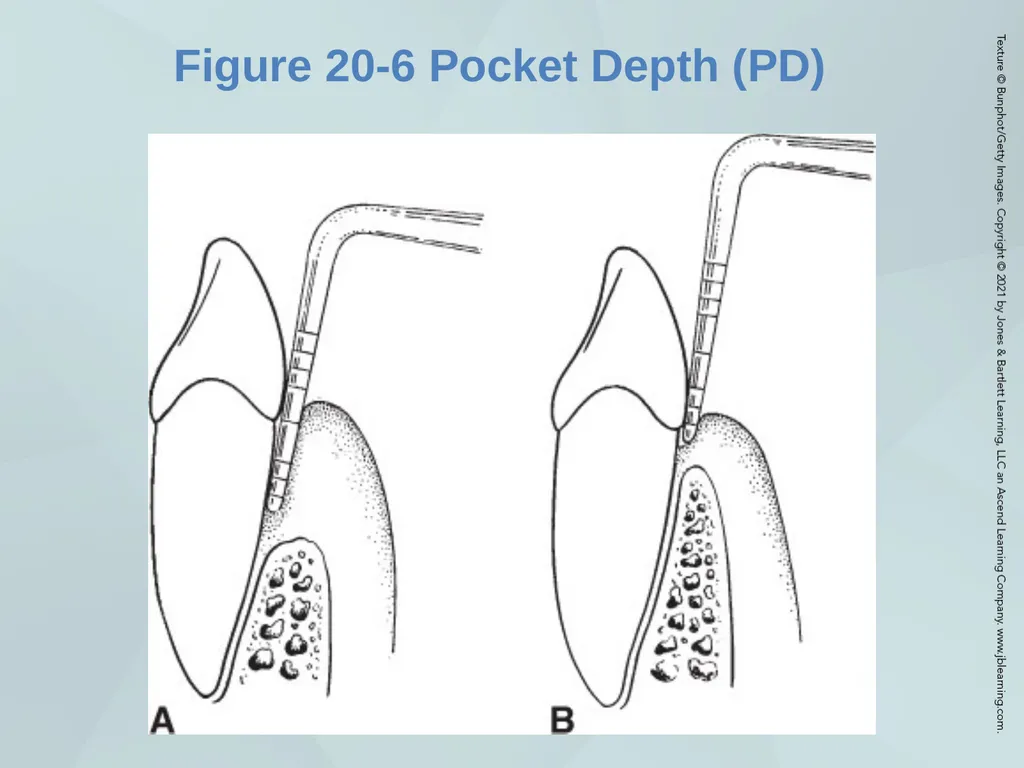 Chapter 20 Periodontal Examination Learning - slide 22 of 49