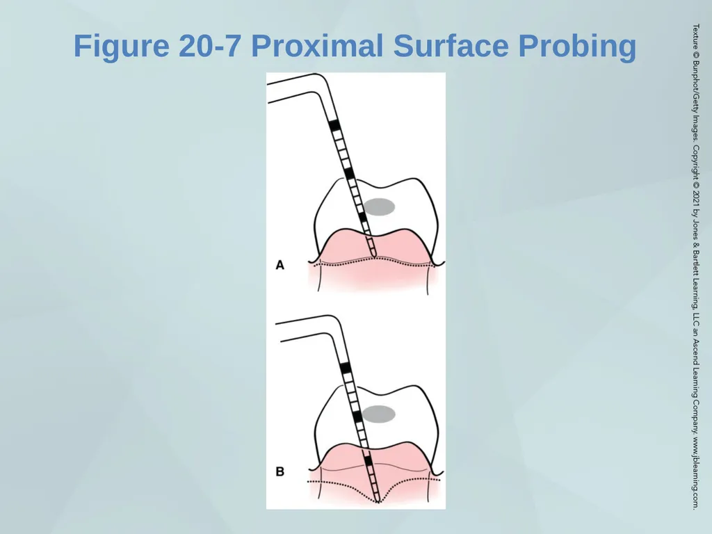Chapter 20 Periodontal Examination Learning - slide 23 of 49