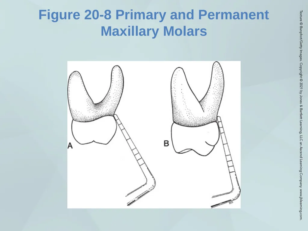 Chapter 20 Periodontal Examination Learning - slide 27 of 49