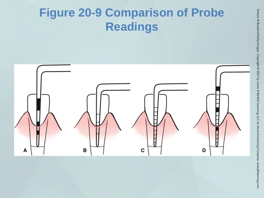 Chapter 20 Periodontal Examination Learning - slide 28 of 49