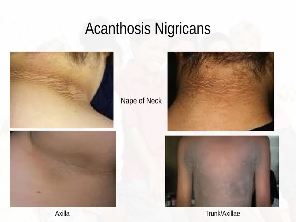 Commonly Seen Infectious and Non-Infectious Skin - slide 83 of 86