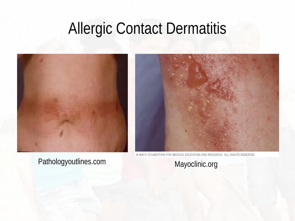 Commonly Seen Infectious and Non-Infectious Skin - slide 34 of 86