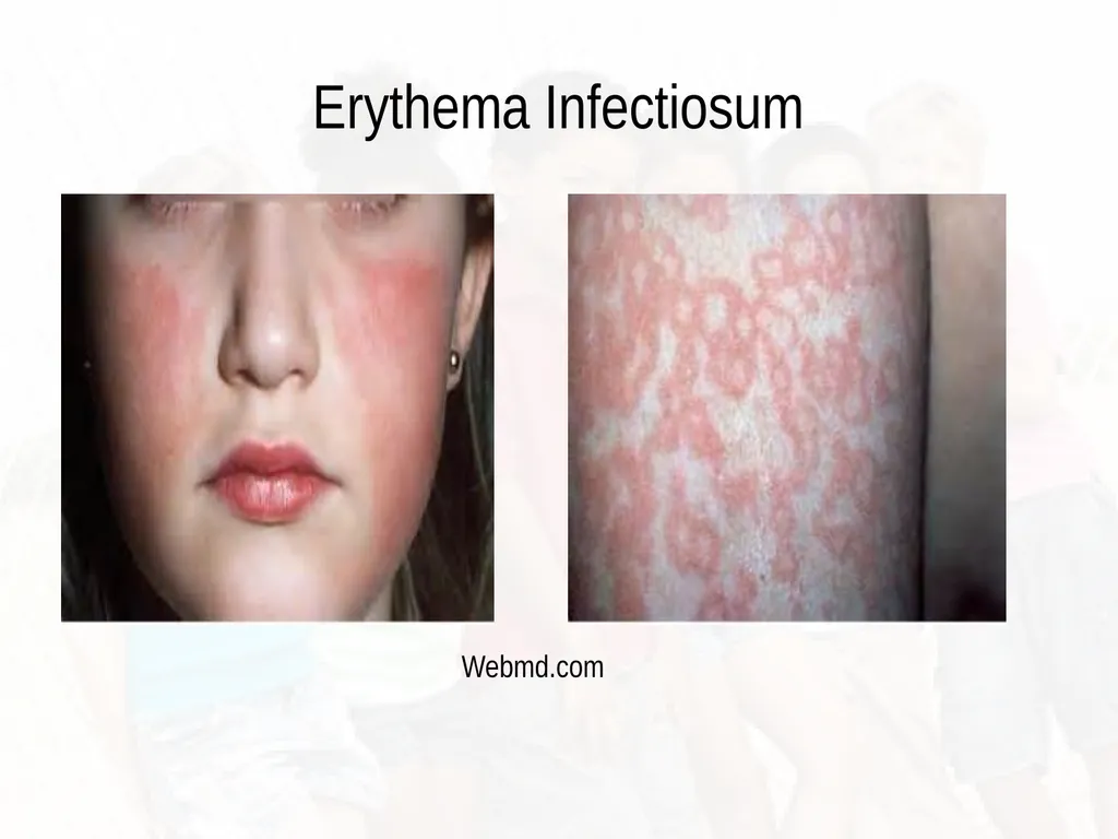 Commonly Seen Infectious and Non-Infectious Skin - slide 66 of 86