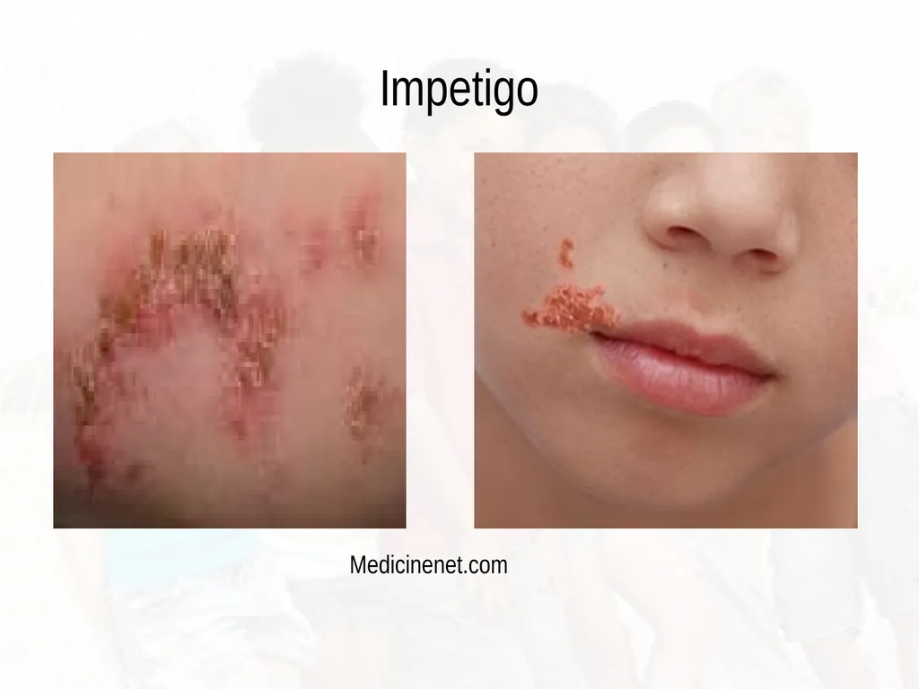 Commonly Seen Infectious and Non-Infectious Skin - slide 40 of 86