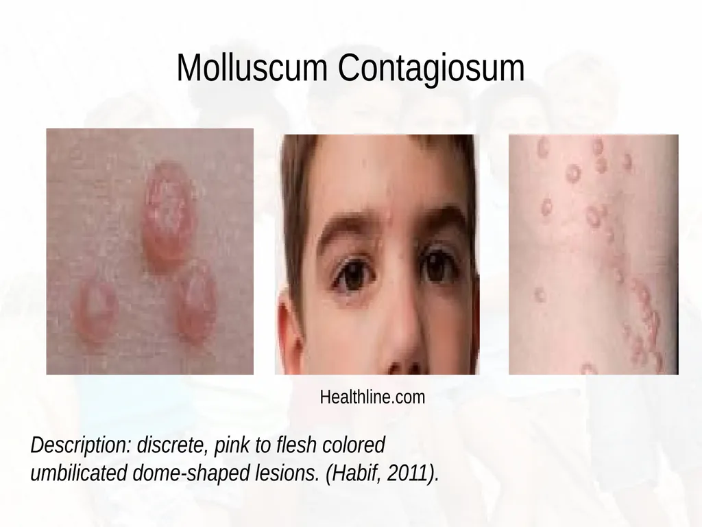 Commonly Seen Infectious and Non-Infectious Skin - slide 54 of 86
