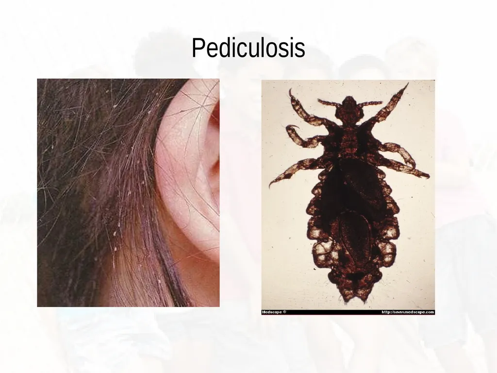 Commonly Seen Infectious and Non-Infectious Skin - slide 74 of 86