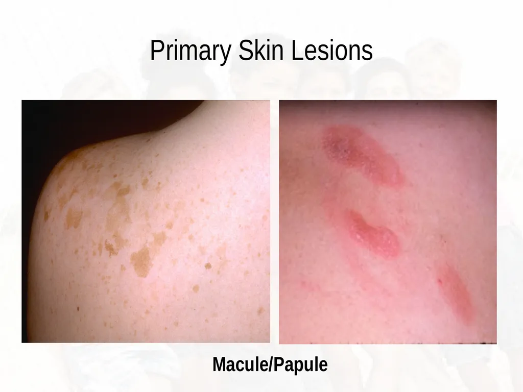 Commonly Seen Infectious and Non-Infectious Skin - slide 20 of 86