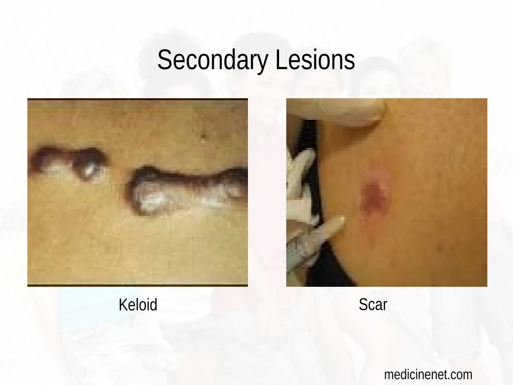 Commonly Seen Infectious and Non-Infectious Skin - slide 22 of 86