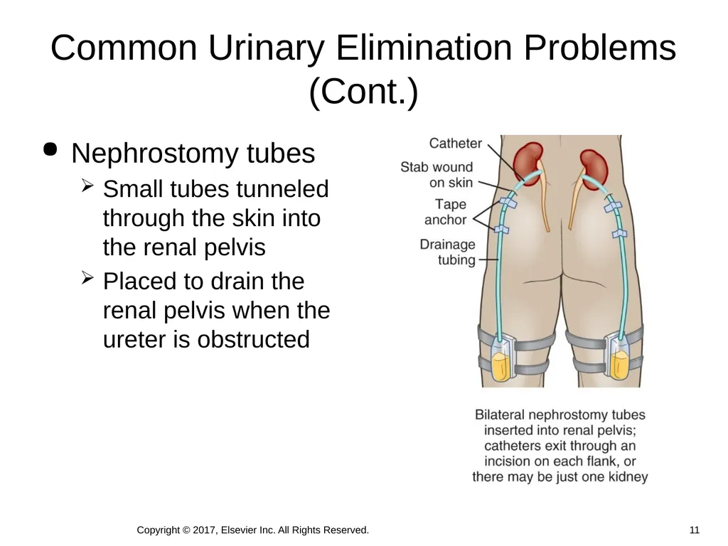 Chapter 46 Urinary Elimination Copyright © 2017, - slide 11 of 39
