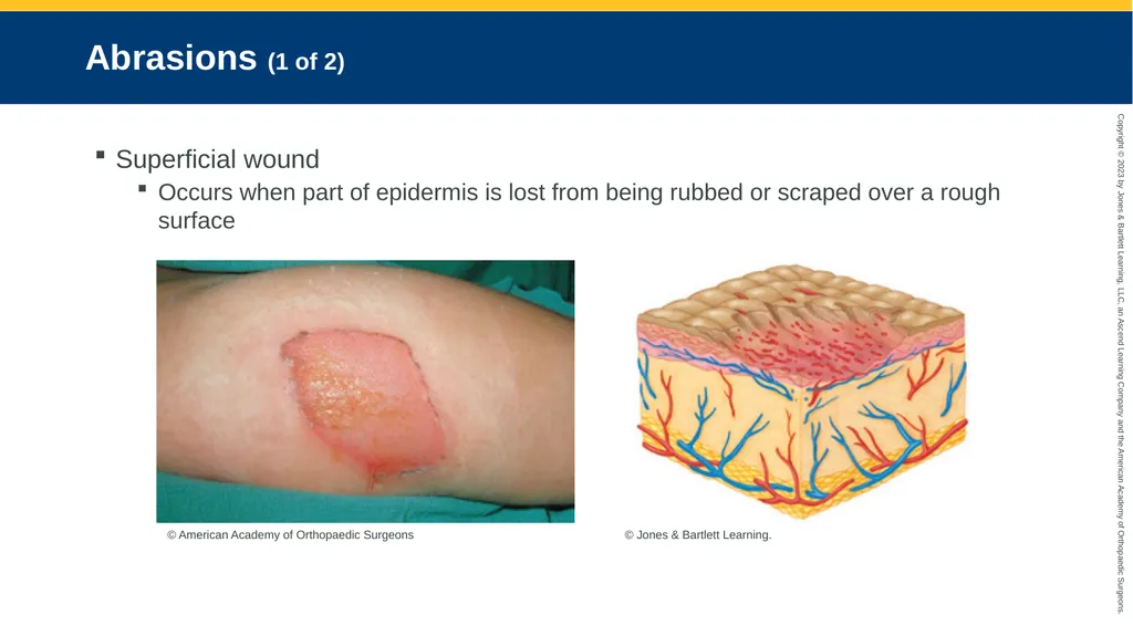 Soft-Tissue Trauma CHAPTER 32 Introduction The - slide 69 of 105
