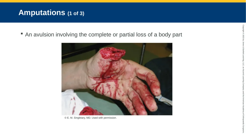 Soft-Tissue Trauma CHAPTER 32 Introduction The - slide 82 of 105