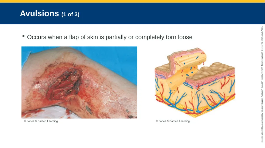 Soft-Tissue Trauma CHAPTER 32 Introduction The - slide 79 of 105