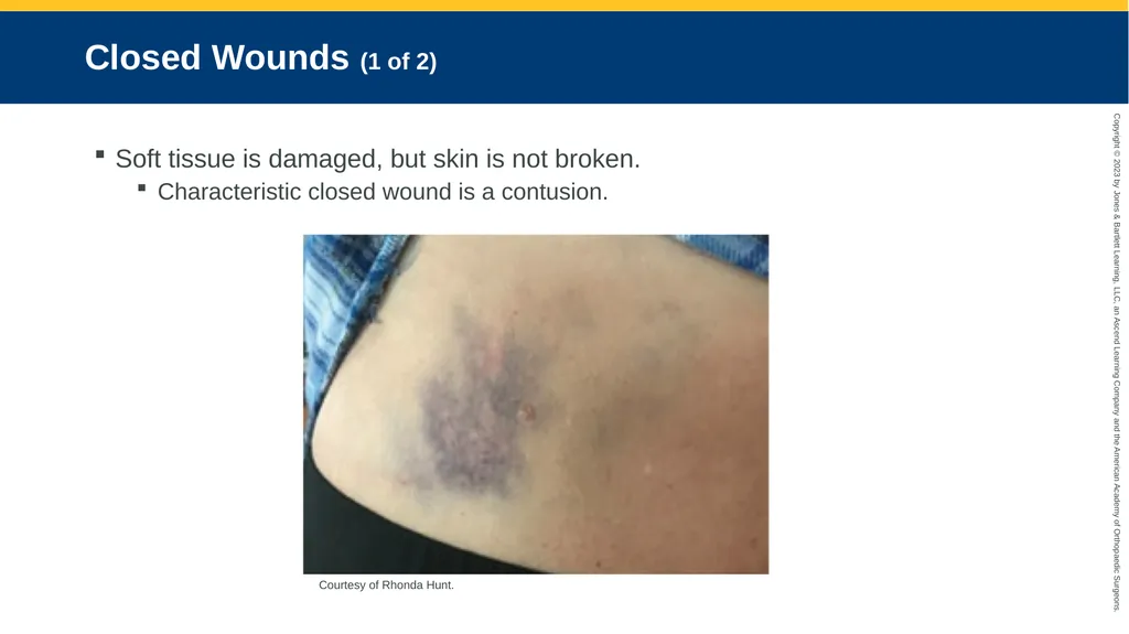 Soft-Tissue Trauma CHAPTER 32 Introduction The - slide 14 of 105