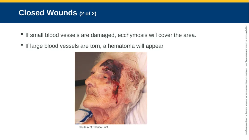 Soft-Tissue Trauma CHAPTER 32 Introduction The - slide 15 of 105