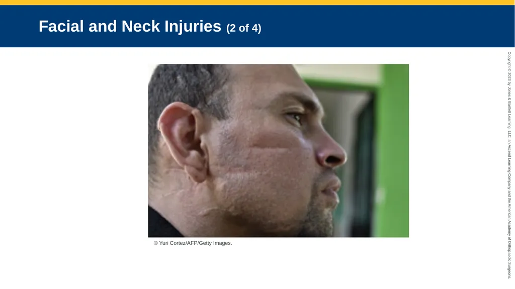 Soft-Tissue Trauma CHAPTER 32 Introduction The - slide 94 of 105