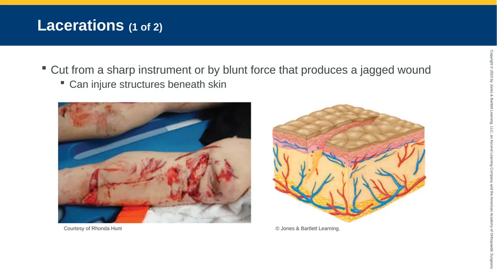 Soft-Tissue Trauma CHAPTER 32 Introduction The - slide 71 of 105