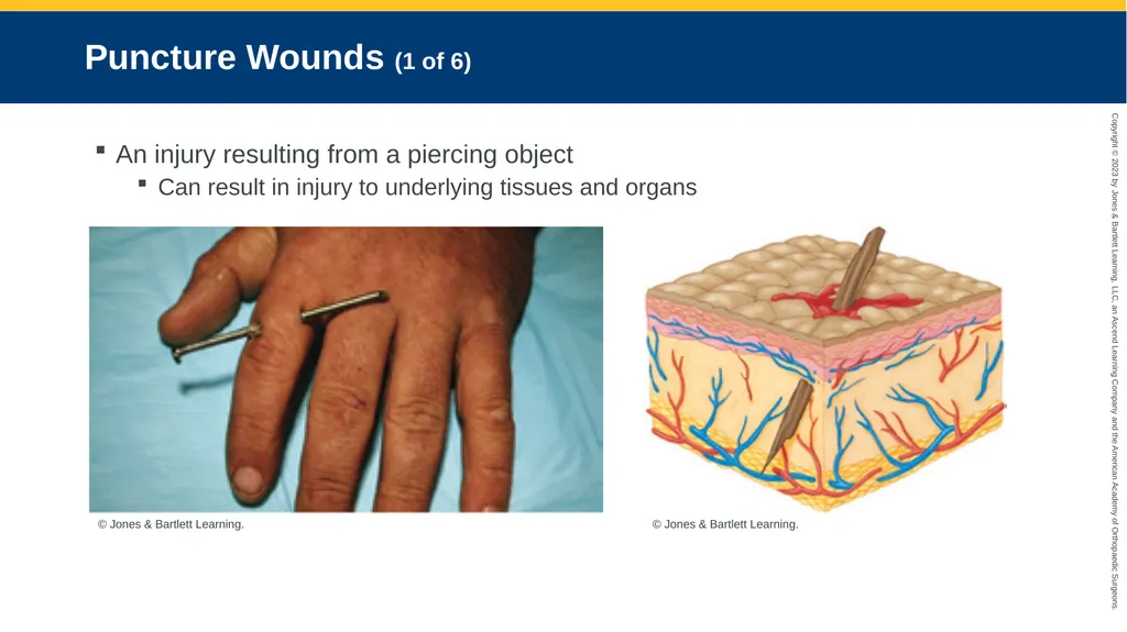 Soft-Tissue Trauma CHAPTER 32 Introduction The - slide 73 of 105