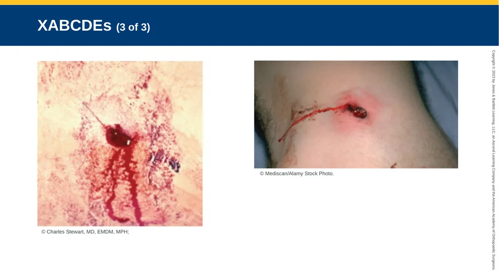 Soft-Tissue Trauma CHAPTER 32 Introduction The - slide 39 of 105