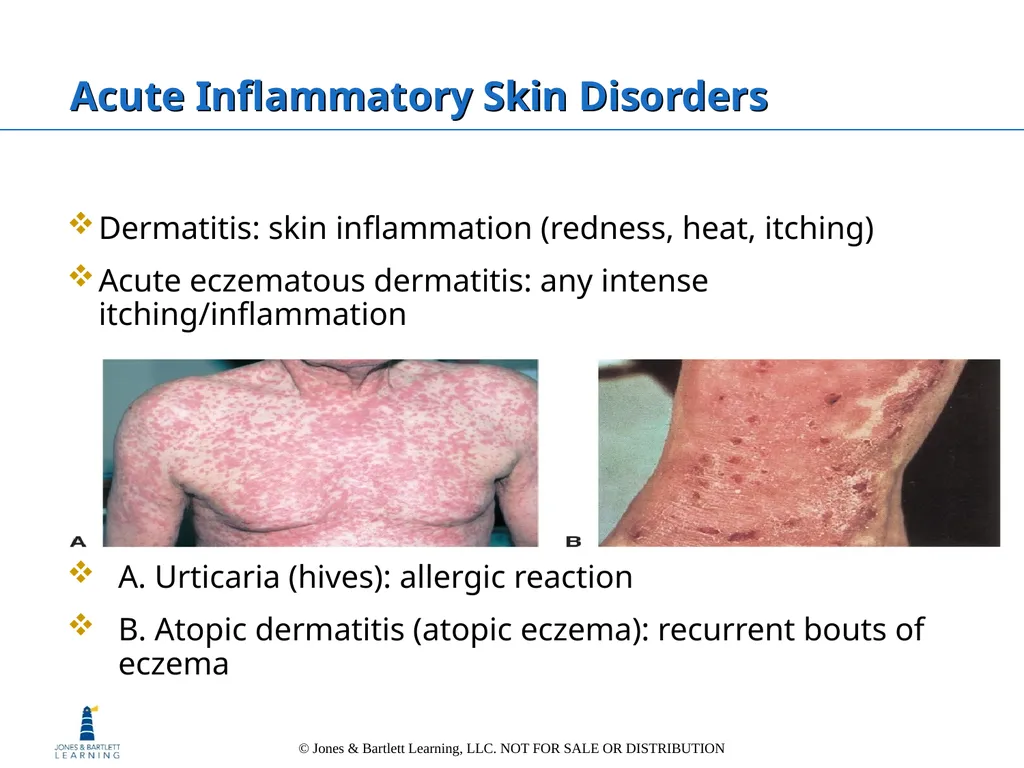 Chapter 6: The Integumentary System Overview Key - slide 68 of 84