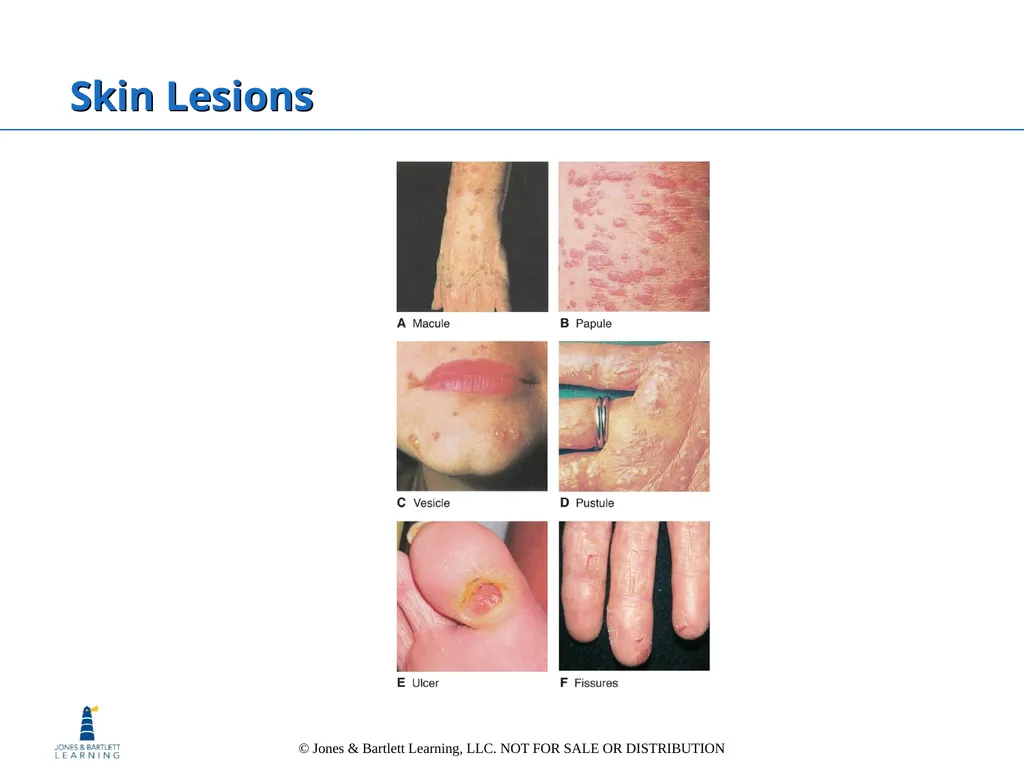 Chapter 6: The Integumentary System Overview Key - slide 60 of 84