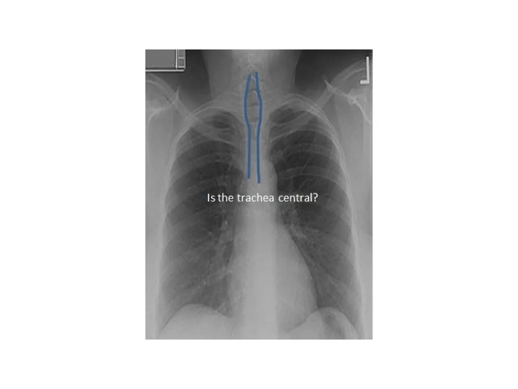 Trachea BY MBBSPPT.COM The Trachea is also called - slide 25 of 32