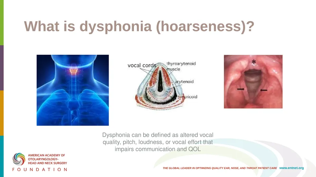 AAO-HNSF Clinical Practice Guideline: Hoarseness - slide 3 of 53