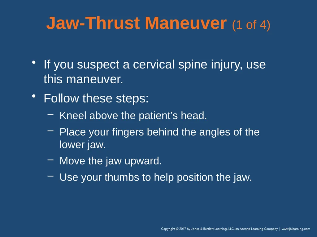 Chapter 10 Airway Management National EMS - slide 59 of 170