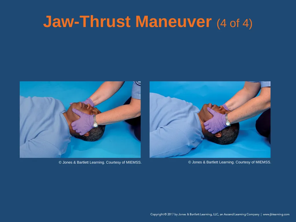 Chapter 10 Airway Management National EMS - slide 62 of 170