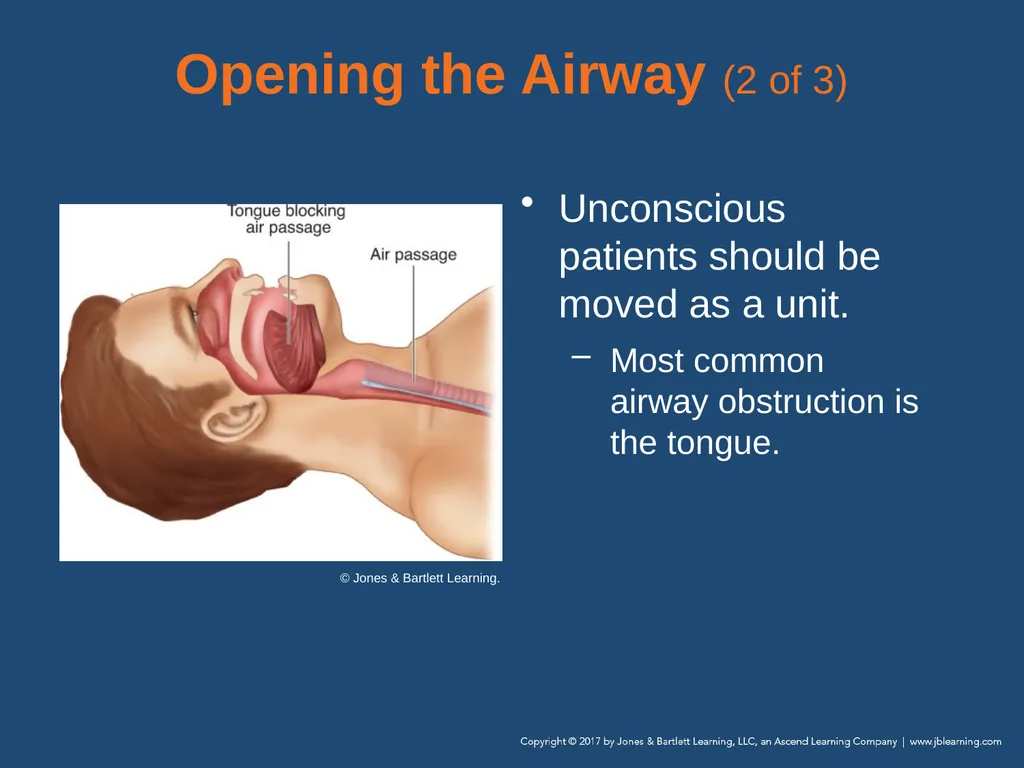 Chapter 10 Airway Management National EMS - slide 55 of 170