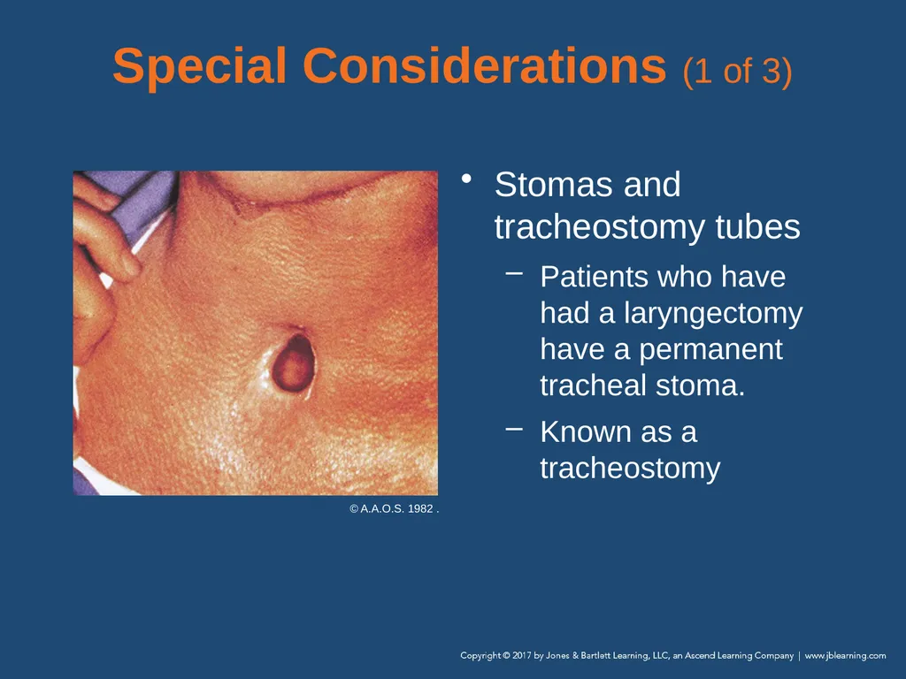 Chapter 10 Airway Management National EMS - slide 119 of 170