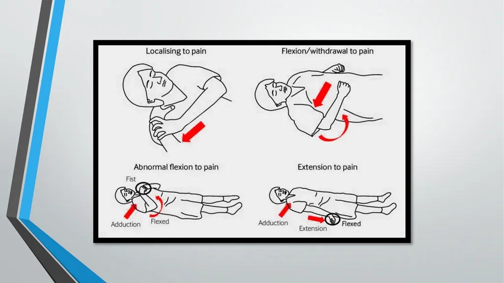Neurological Assessment Overview By: Aliyah - slide 18 of 49