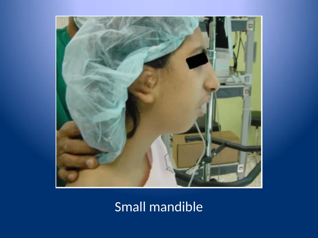 Complications of Rapid Sequence Induction and - slide 13 of 35