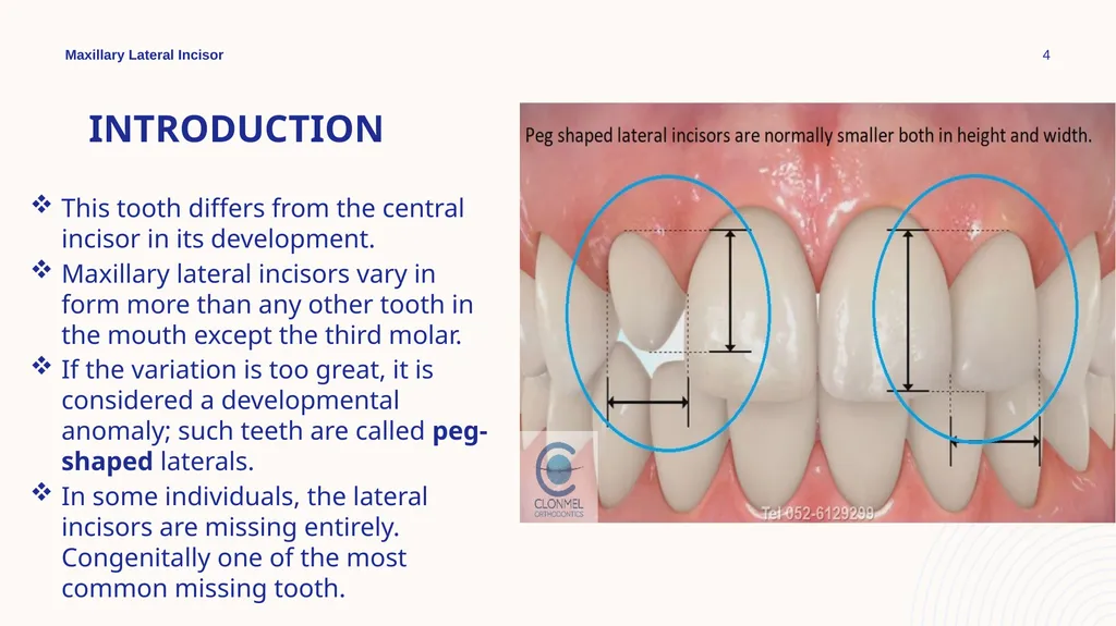 Maxillary Lateral Incisor Dr. Pinar Khalis BDS, - slide 4 of 20