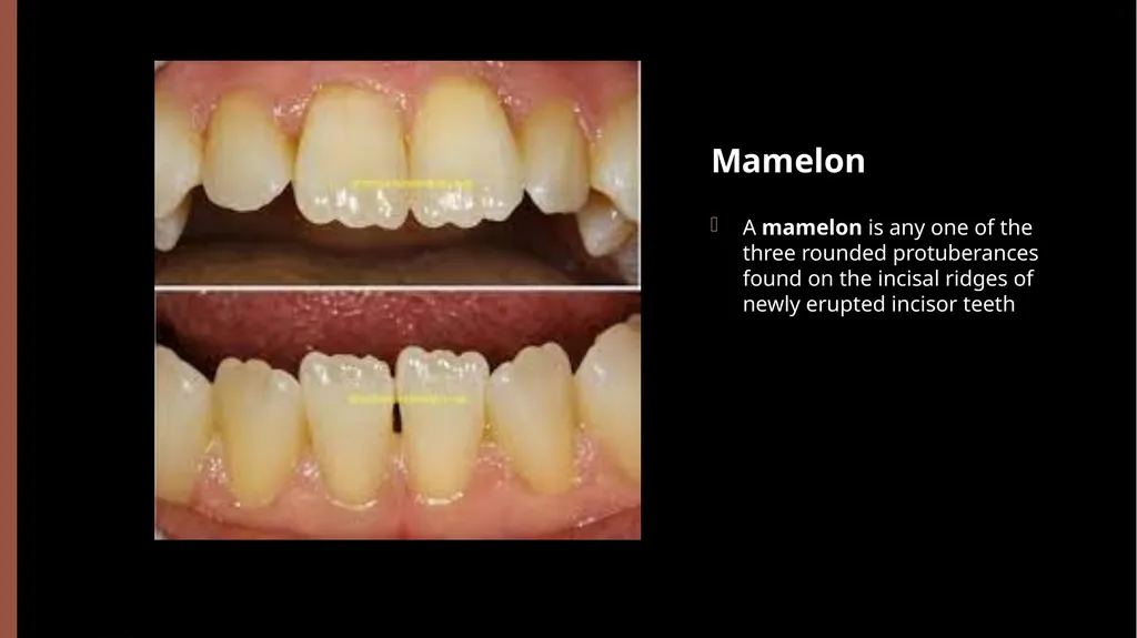 The Permanent Maxillary Incisors Dr. Pinar Khalis - slide 14 of 28
