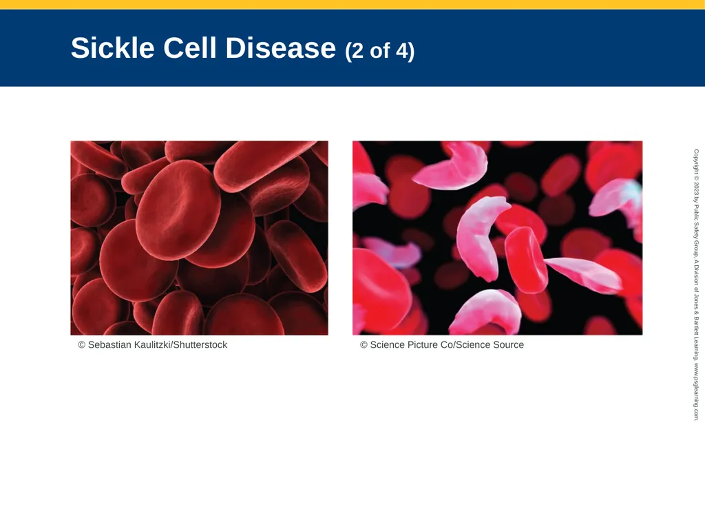 Endocrine and Hematologic Emergencies CHAPTER 21: - slide 49 of 67