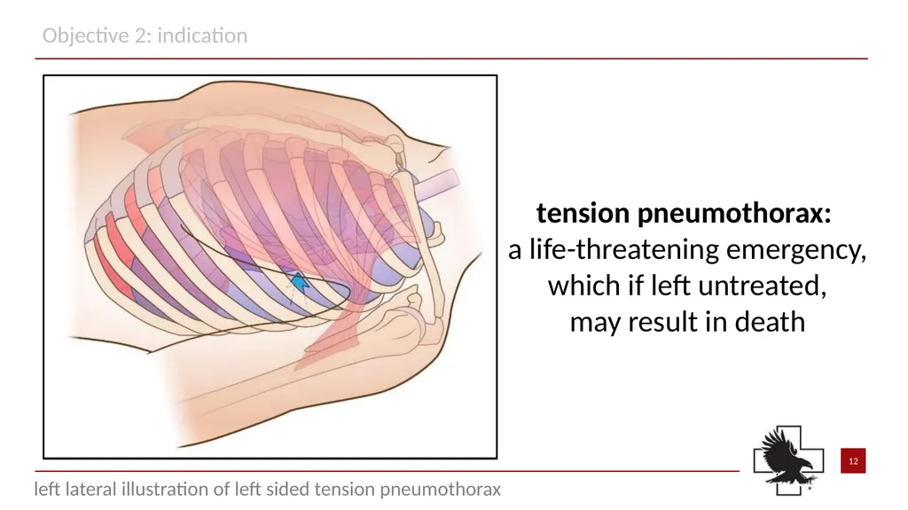 S P E A R™ decompression needle system Simplified - slide 12 of 36