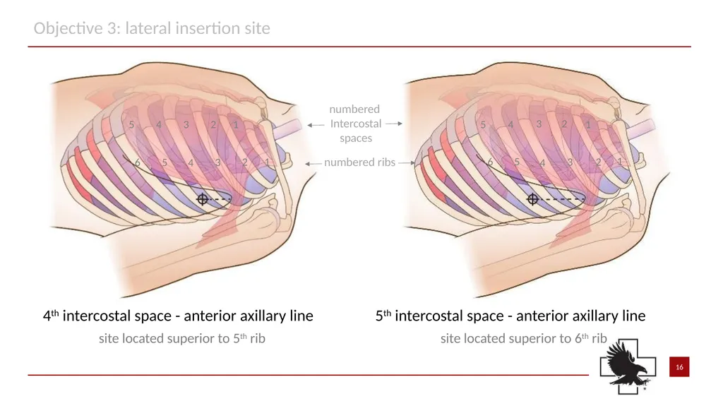 S P E A R™ decompression needle system Simplified - slide 16 of 36