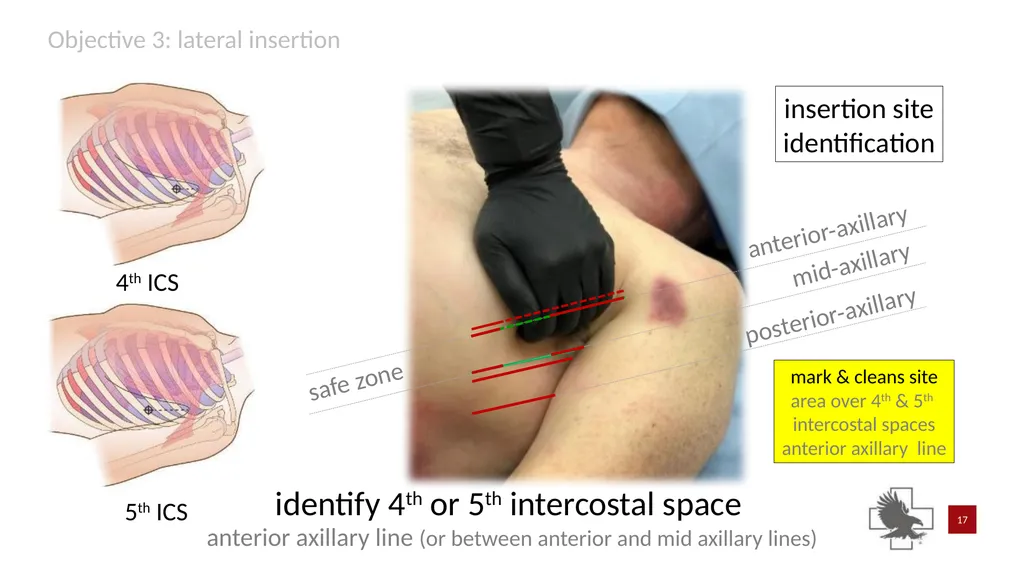 S P E A R™ decompression needle system Simplified - slide 17 of 36