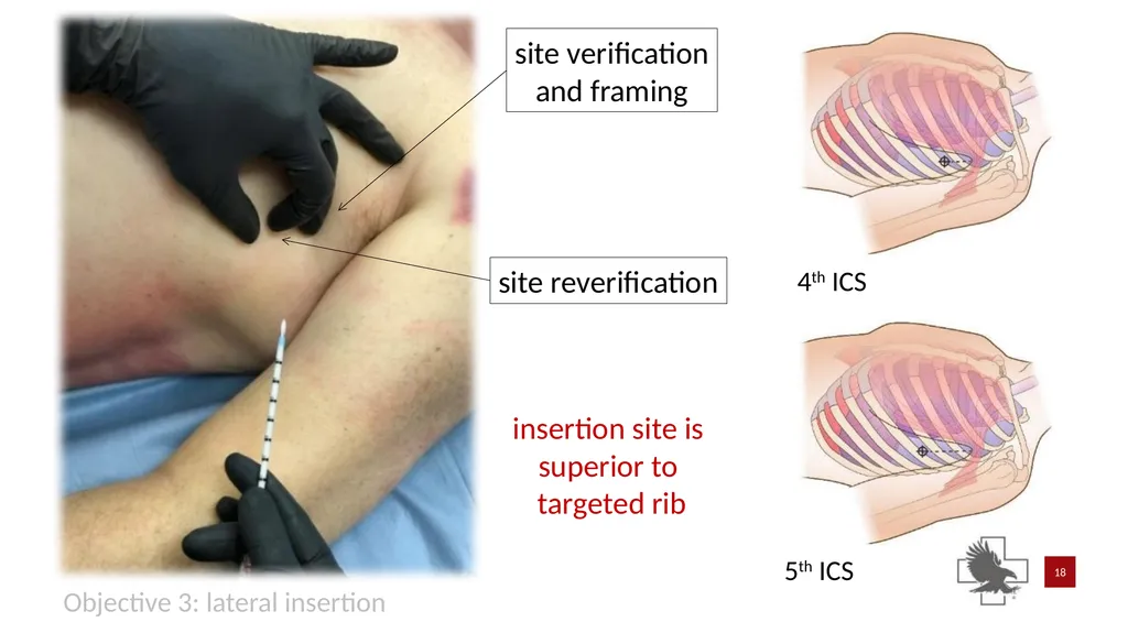S P E A R™ decompression needle system Simplified - slide 18 of 36