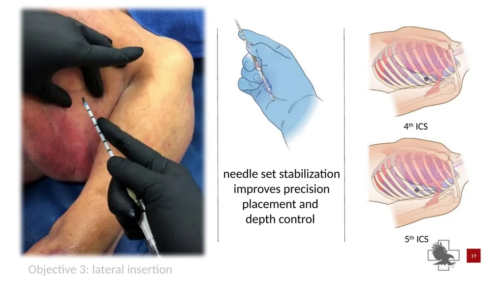 S P E A R™ decompression needle system Simplified - slide 19 of 36