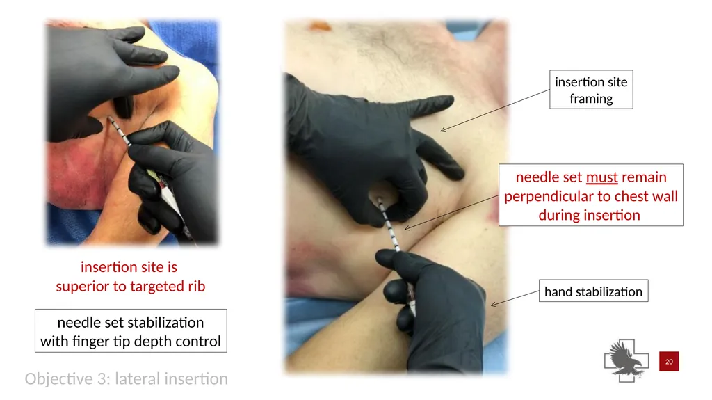 S P E A R™ decompression needle system Simplified - slide 20 of 36
